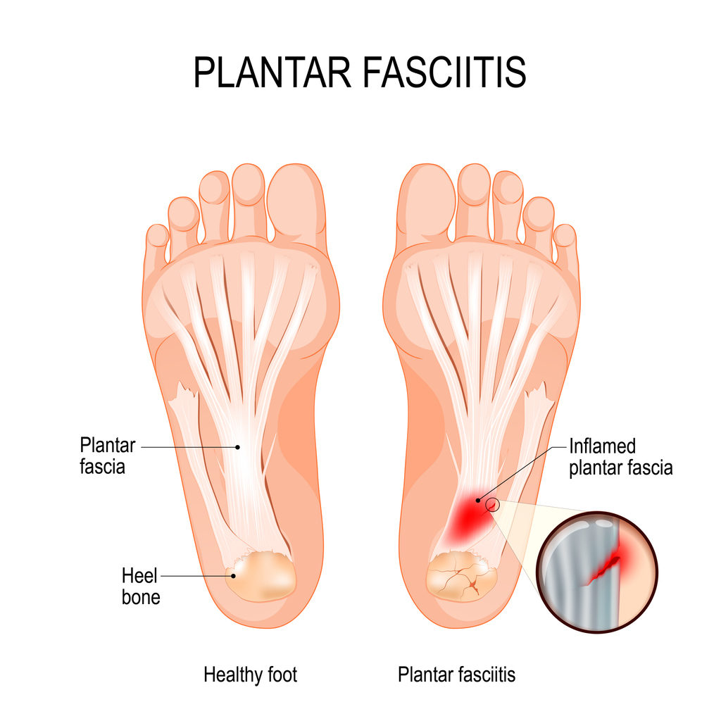 Fascitis Plantar